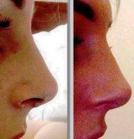 Dr. Stephen W. Perkins Cosmetic Surgery Nose Reshaping Before After