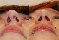 Eviated Nasal Septum Before And After