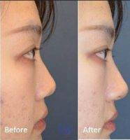 Gold Coast Asian Nose Surgery Before And After