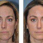 How To Fix A Twisted Nose By Rhinoplasty
