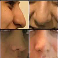 Iranian Nose Job Based On Standards Of Beauty In Tehran