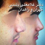 Iranian Nose Job Pictures (2)