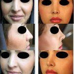 Iranian Nose Operation Before And After (2)