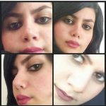 Iranian Nose Operation Before And After (3)