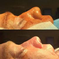 It Is Normal To Feel Congested And Have Swelling Around The Face And Eyes After Rhinoplasty