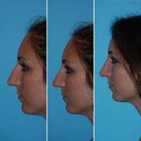 It May Take Up To A Year For Your Nose To Have The Final Result After Nose Job