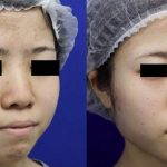 Korean Flat Nose Before After