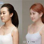 Korean Flat Nose Surgery Before After (1)