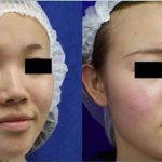 Korean Flat Nose Surgery Before After (3)