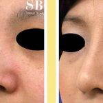 Korean Flat Nose Surgery Before After (4)