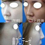 Korean Nose Augmentation Photos Before And After (1)