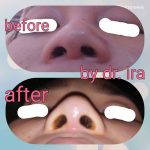 Korean Nose Filler Before And After Photo