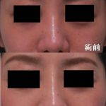 Korean Nose Job Before And After Pictures (3)
