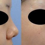 Korean Nose Job Before And After Pictures (4)