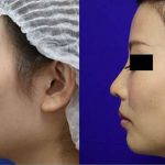 Korean Nose Job Before And After Pictures (8)