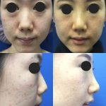 Korean Nose Job Involves The Use Of An Implant