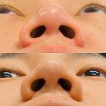 Korean Nose Job Photo (3)
