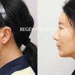 Korean Nose Job Preop And Postop Photos (1)