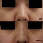 Korean Nose Job Preop And Postop Photos (2)