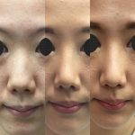 Korean Nose Lifter Photos Before After