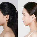 Korean Nose Plastic Surgery (1)