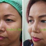 Korean Nose Plastic Surgery (2)