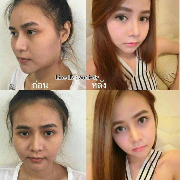 Korean Nose Plastic Surgery Before And After » Rhinoplasty