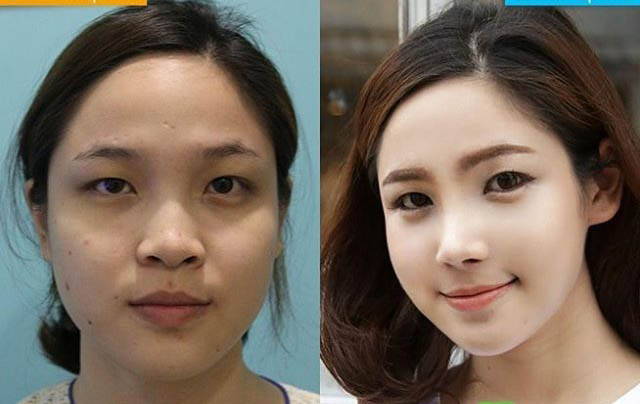 Korean Perfect Nose Rhinoplasty Cost Pics Reviews Q A