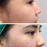 Korean Plastic Surgery Rhinoplasty (4)