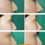 Korean Rhinoplasty Before And After Photos (4)