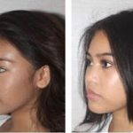 Korean Rhinoplasty Before And After Photos (5)