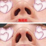 Korean Rhinoplasty Before And After Photos (8)