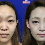 Korean Rhinoplasty Before And After Pictures (3)