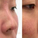 Korean Rhinoplasty Before And After Pictures (4)