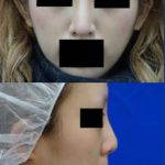 Korean Rhinoplasty Procedure (1)
