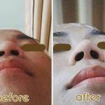Korean Rhinoplasty To Have A Taller Nose