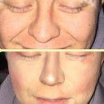 Large Bulbous Nose Correction Photos