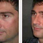 Male Bulbous Nose Before And After Plastic Surgery For Nose