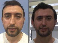Male Crooked Nose Before And After Rhinoplasty
