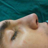 Male Nose Operation In Queensland Pic