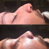 Male Nose Reshaping Photo Before And After
