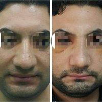 Male Rhinoplasty Before And After Bulbous Tip