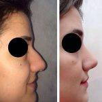 Maryland Nose Op to restore better symmetry or correct the damage