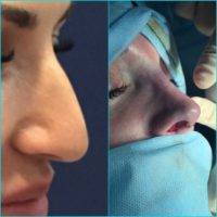 Maryland Rhinoplasty For Tip Of Nose By Dr. Randolph B. Capone
