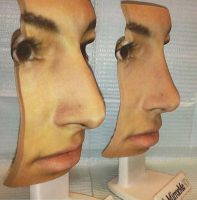 MirrorMe3D Printing In Rhinoplasty Cosmetic Surgery