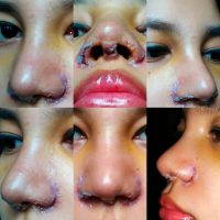 Most Bruising And Swelling Occurs In The First 3-5 Days After Nose Job