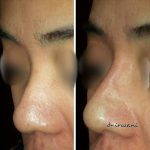 Nasal Tip May Also Be Augmented