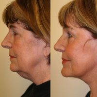 Nose After Rhinoplasty May Often Appear Asymmetric Due To The Slow Resolution Of The Swelling