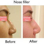 Nose Augmentation Before And After (2)