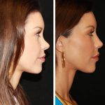 Nose Augmentation Before And After Images (1)